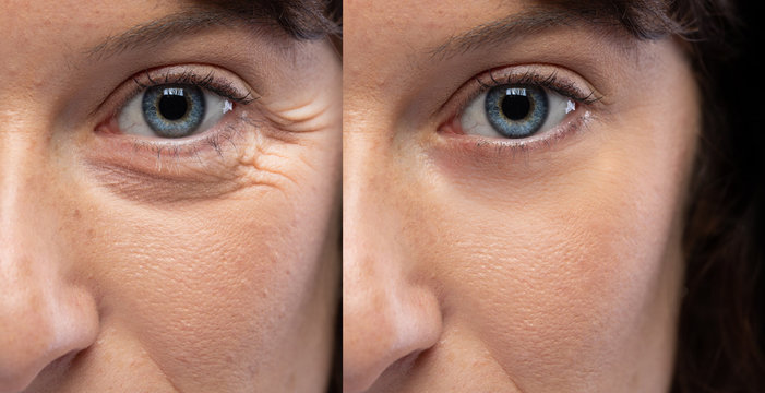 WRINKLES AND DERMA FILLERS