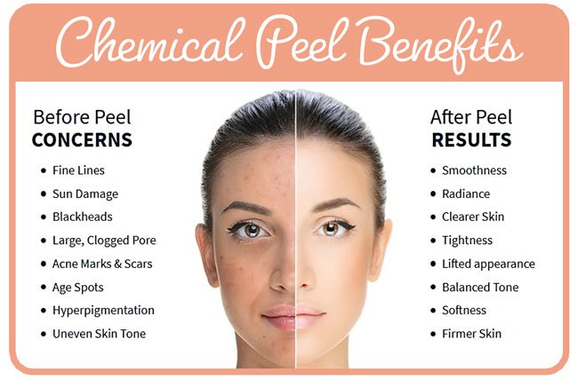 All about Chemical Peels: Benefits, Risks, and What to Expect