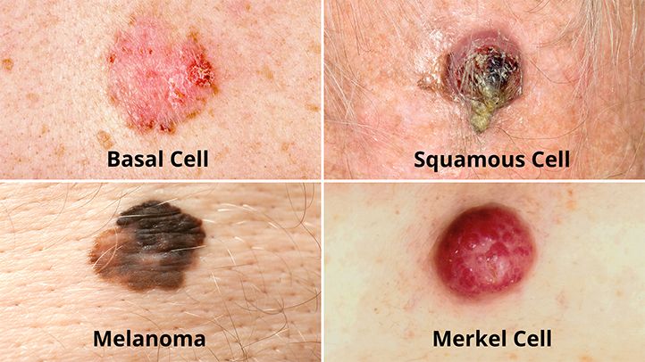 SKIN CANCER